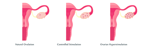 Ovarian Hyperstimulation Syndrome (OHSS) Causes, Symptoms, Risks ...