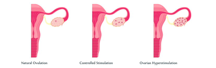 Ovarian Hyperstimulation Syndrome (OHSS) Causes, Symptoms, Risks ...
