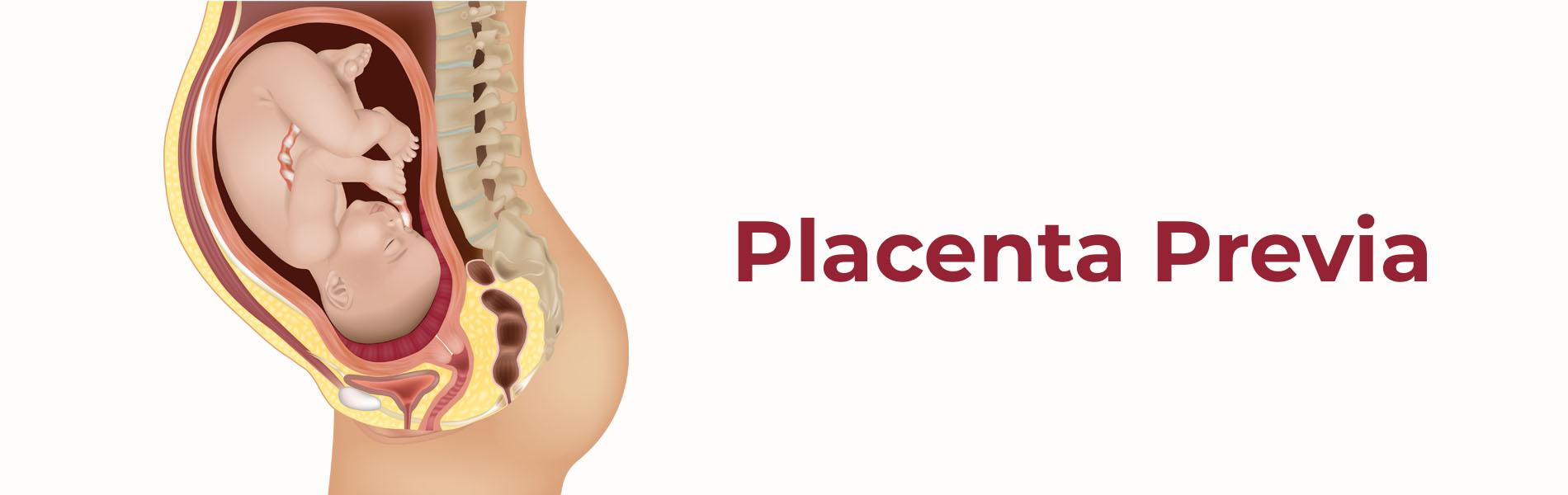 Placenta Previa: Symptoms, Causes & Treatments