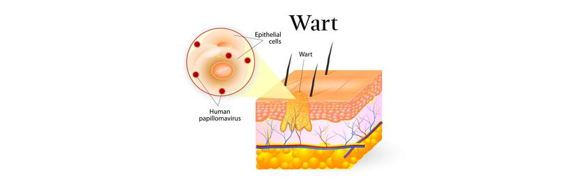 What Are HPV Genital Warts Signs You Should Know what-are-hpv-genital-warts-signs-you-should-know
